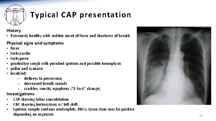 Typical CAP presentation History • Previously healthy with sudden onset of fever and shortness