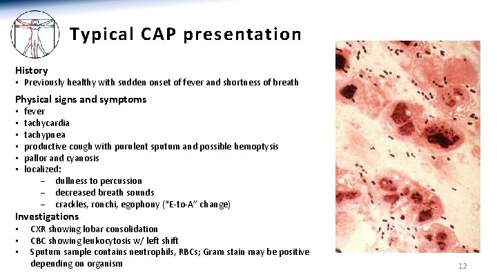 Typical CAP presentation History • Previously healthy with sudden onset of fever and shortness