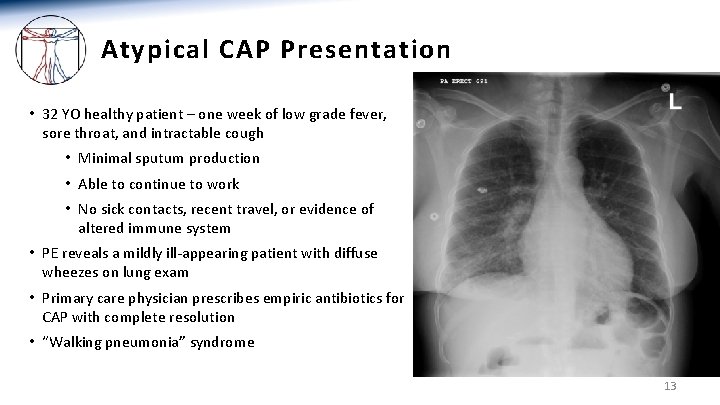 Atypical CAP Presentation • 32 YO healthy patient – one week of low grade