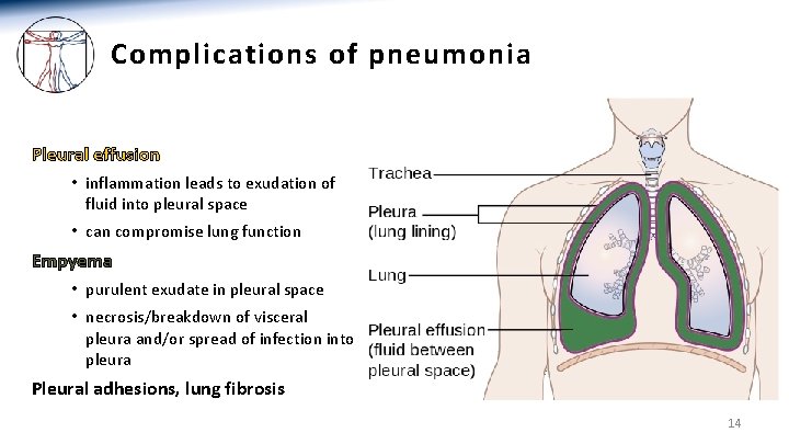 Complications of pneumonia Pleural effusion • inflammation leads to exudation of fluid into pleural