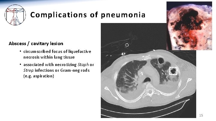 Complications of pneumonia Abscess / cavitary lesion • circumscribed focus of liquefactive necrosis within