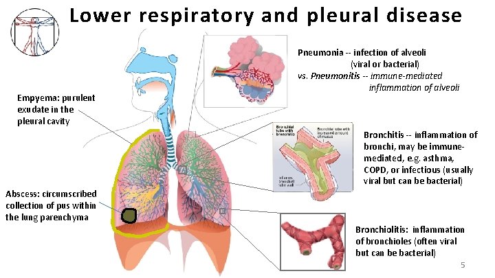 Lower respiratory and pleural disease Empyema: purulent exudate in the pleural cavity Pneumonia --