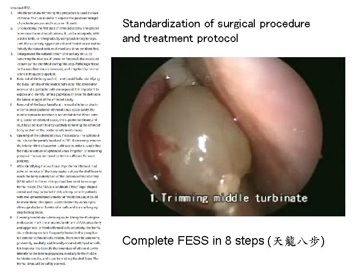 Standardization of surgical procedure and treatment protocol Complete FESS in 8 steps (天龍八步) 