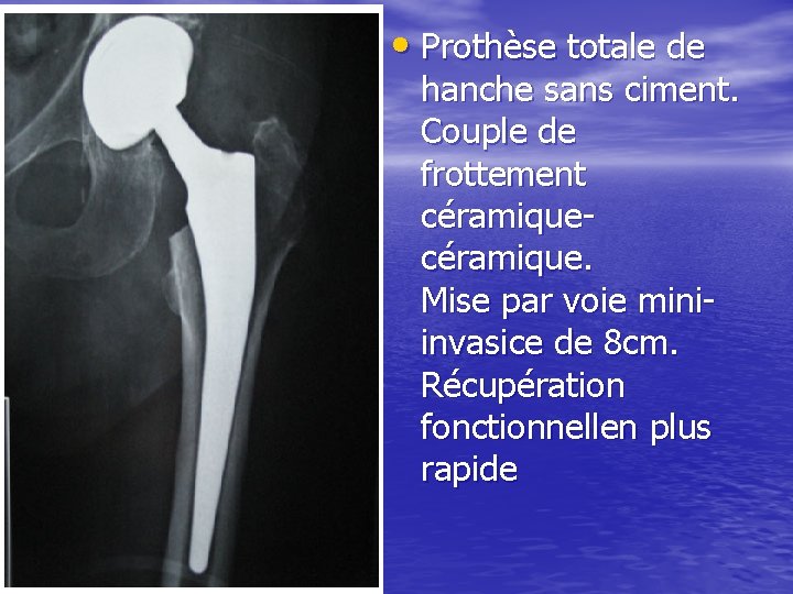  • Prothèse totale de hanche sans ciment. Couple de frottement céramique. Mise par