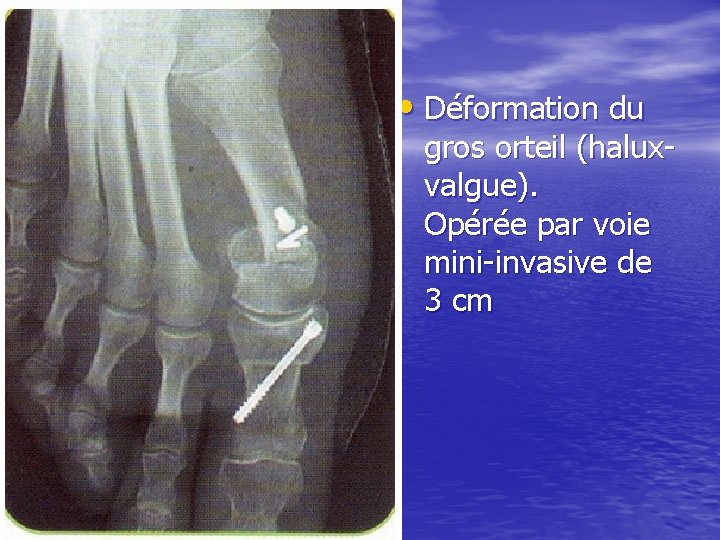  • Déformation du gros orteil (haluxvalgue). Opérée par voie mini-invasive de 3 cm