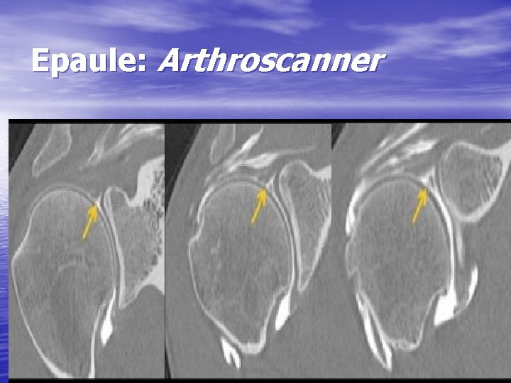 Epaule: Arthroscanner 