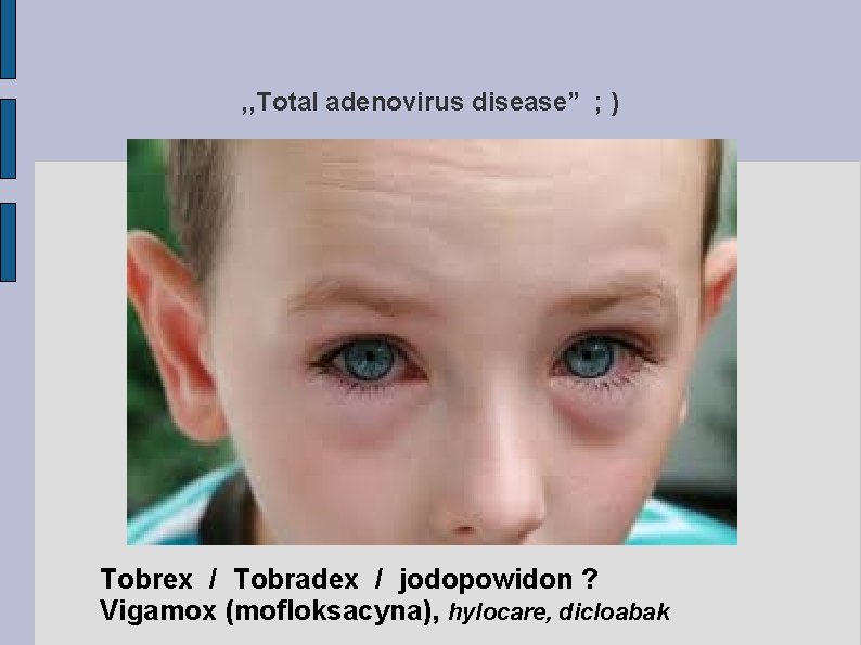 , , Total adenovirus disease” ; ) Tobrex / Tobradex / jodopowidon ? Vigamox