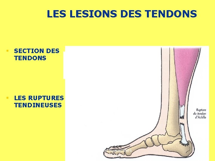 LES LESIONS DES TENDONS § SECTION DES TENDONS § LES RUPTURES TENDINEUSES Prévention des