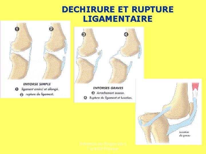 DECHIRURE ET RUPTURE LIGAMENTAIRE Prévention des Risques liés à l’Activité Physique 6 