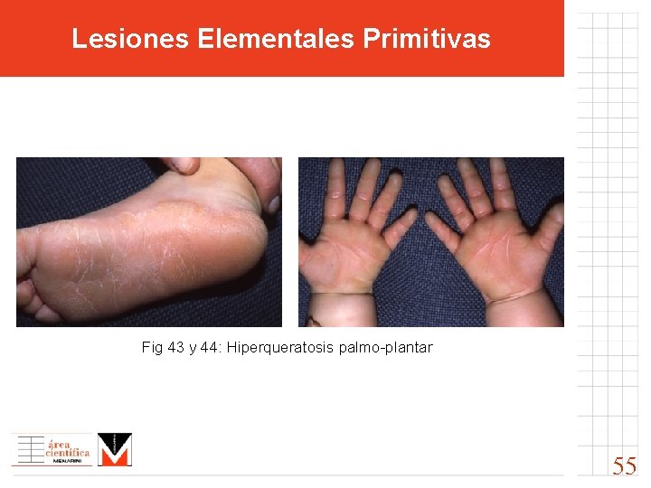 Lesiones Elementales Primitivas Fig 43 y 44: Hiperqueratosis palmo-plantar 55 