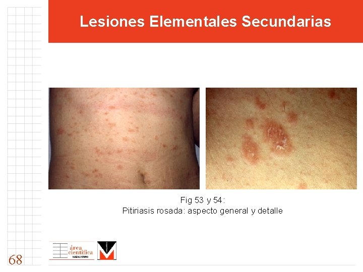 Lesiones Elementales Secundarias Fig 53 y 54: Pitiriasis rosada: aspecto general y detalle 68