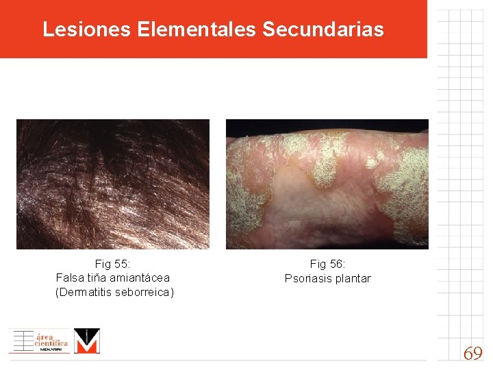 Lesiones Elementales Secundarias Fig 55: Falsa tiña amiantácea (Dermatitis seborreica) Fig 56: Psoriasis plantar