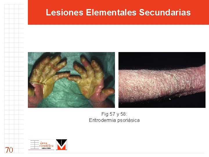 Lesiones Elementales Secundarias Fig 57 y 58: Eritrodermia psoriásica 70 