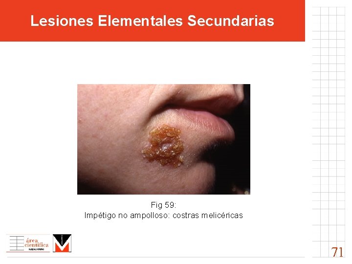 Lesiones Elementales Secundarias Fig 59: Impétigo no ampolloso: costras melicéricas 71 