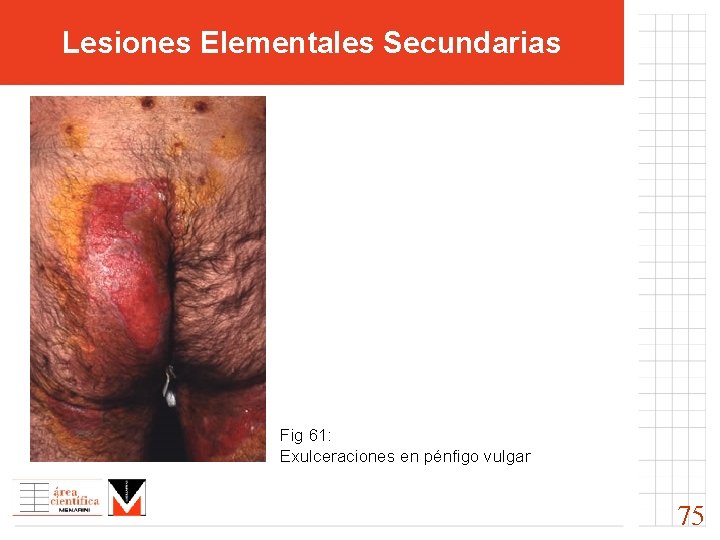 Lesiones Elementales Secundarias Fig 61: Exulceraciones en pénfigo vulgar 75 