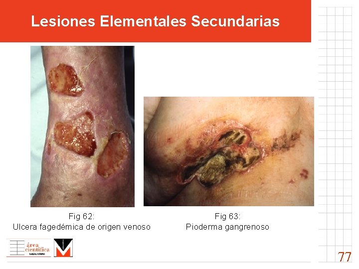 Lesiones Elementales Secundarias Fig 62: Ulcera fagedémica de origen venoso Fig 63: Pioderma gangrenoso