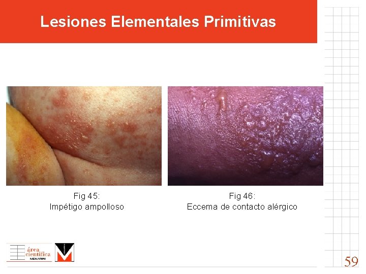 Lesiones Elementales Primitivas Fig 45: Impétigo ampolloso Fig 46: Eccema de contacto alérgico 59