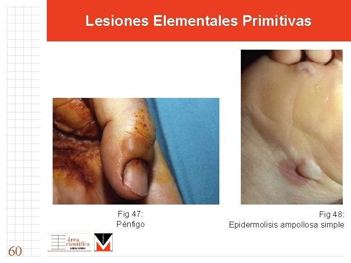 Lesiones Elementales Primitivas Fig 47: Pénfigo 60 Fig 48: Epidermolisis ampollosa simple 