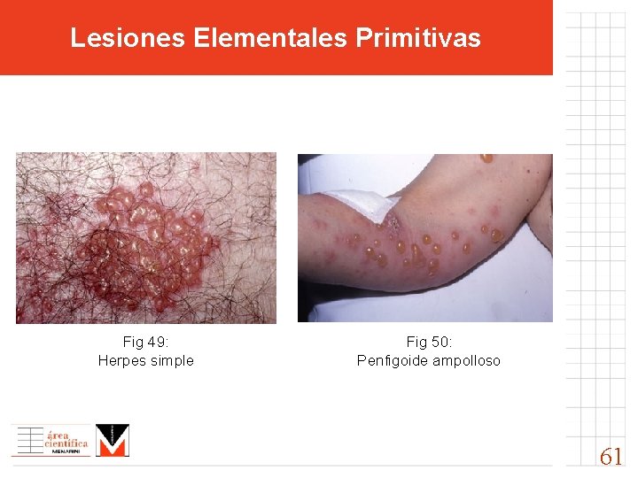 Lesiones Elementales Primitivas Fig 49: Herpes simple Fig 50: Penfigoide ampolloso 61 