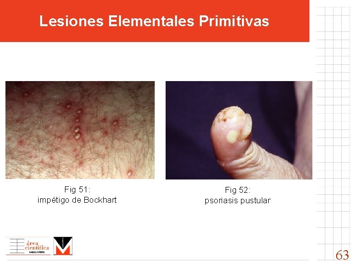 Lesiones Elementales Primitivas Fig 51: impétigo de Bockhart Fig 52: psoriasis pustular 63 