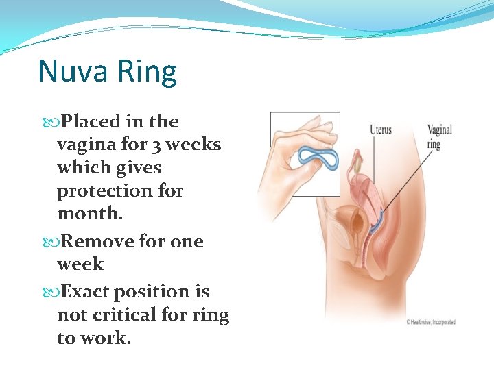 Nuva Ring Placed in the vagina for 3 weeks which gives protection for month.