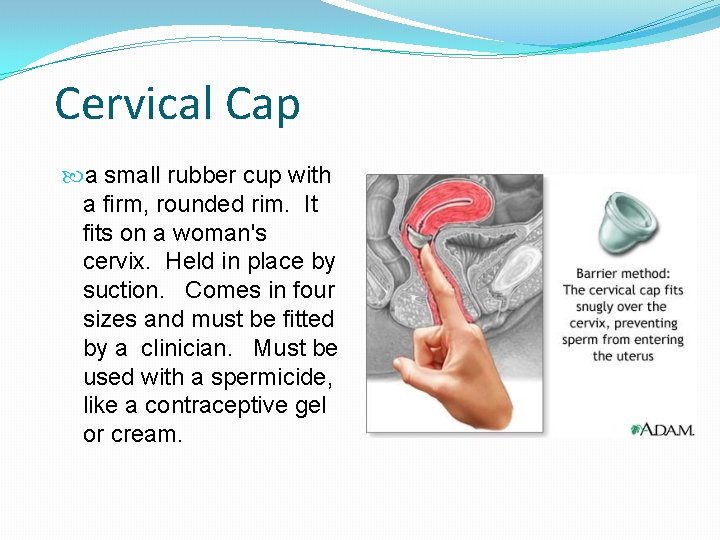 Cervical Cap a small rubber cup with a firm, rounded rim. It fits on