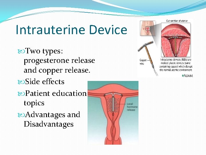 Intrauterine Device Two types: progesterone release and copper release. Side effects Patient education topics