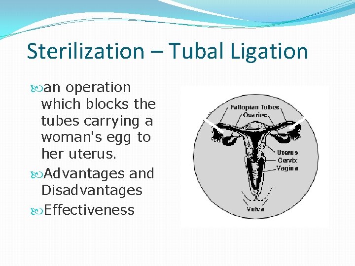 Sterilization – Tubal Ligation an operation which blocks the tubes carrying a woman's egg