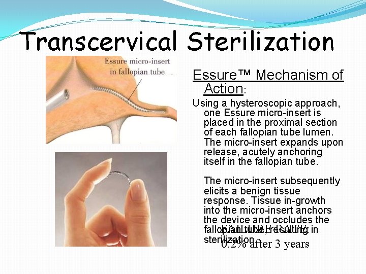 Transcervical Sterilization Essure™ Mechanism of Action: Using a hysteroscopic approach, one Essure micro-insert is