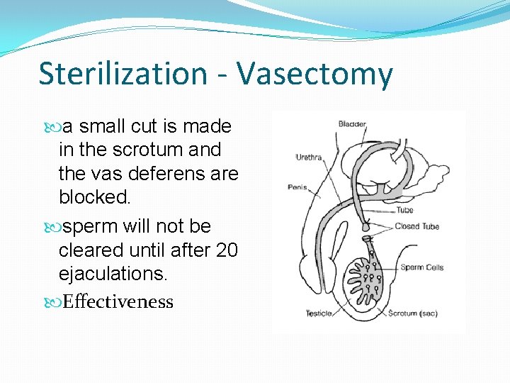 Sterilization - Vasectomy a small cut is made in the scrotum and the vas