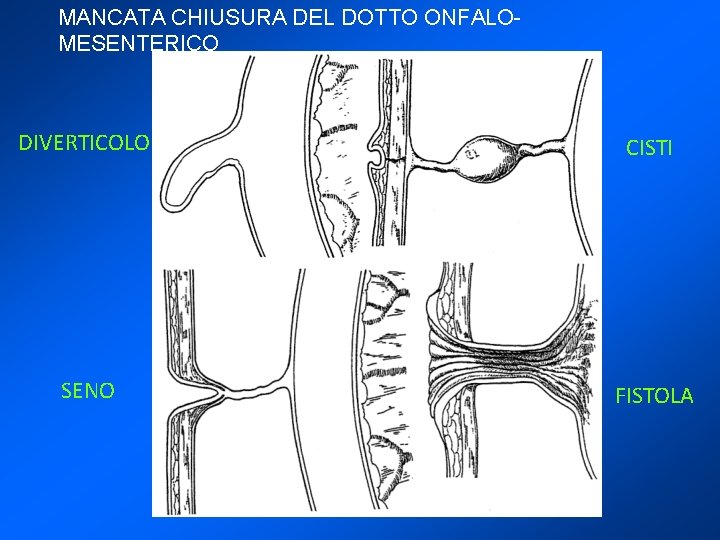 MANCATA CHIUSURA DEL DOTTO ONFALOMESENTERICO DIVERTICOLO CISTI SENO FISTOLA 