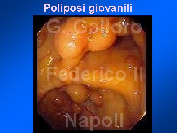 Poliposi giovanili 