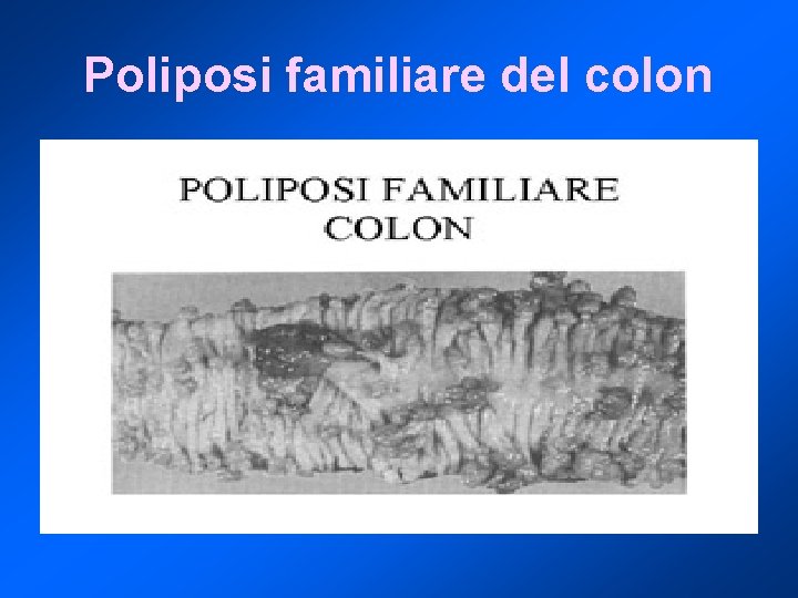 Poliposi familiare del colon 