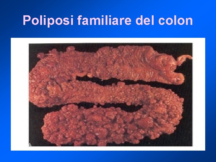 Poliposi familiare del colon 