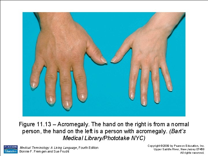 Figure 11. 13 – Acromegaly. The hand on the right is from a normal