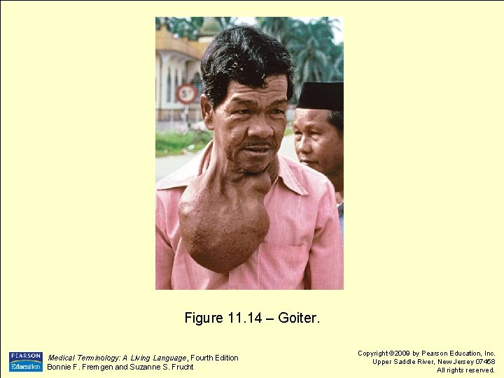 Figure 11. 14 – Goiter. Medical Terminology: A Living Language, Fourth Edition Bonnie F.