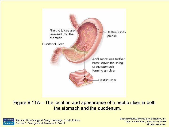 Figure 8. 11 A – The location and appearance of a peptic ulcer in