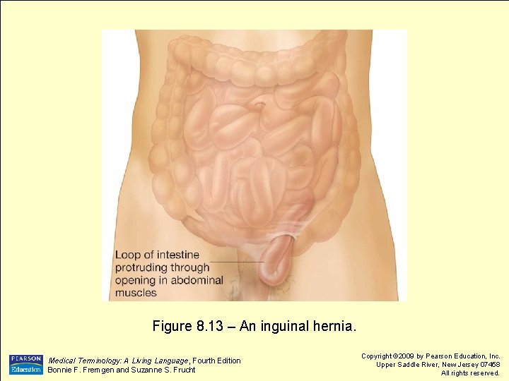 Figure 8. 13 – An inguinal hernia. Medical Terminology: A Living Language, Fourth Edition