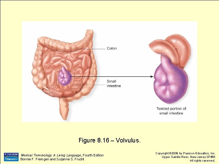 Figure 8. 16 – Volvulus. Medical Terminology: A Living Language, Fourth Edition Bonnie F.