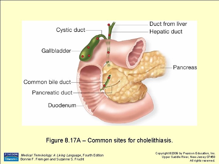 Figure 8. 17 A – Common sites for cholelithiasis. Medical Terminology: A Living Language,