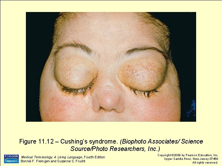 Figure 11. 12 – Cushing’s syndrome. (Biophoto Associates/ Science Source/Photo Researchers, Inc. ) Medical