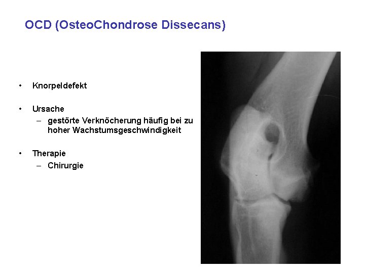 OCD (Osteo. Chondrose Dissecans) • Knorpeldefekt • Ursache – gestörte Verknöcherung häufig bei zu