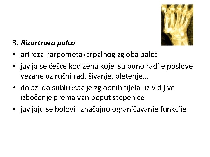 3. Rizartroza palca • artroza karpometakarpalnog zgloba palca • javlja se češće kod žena