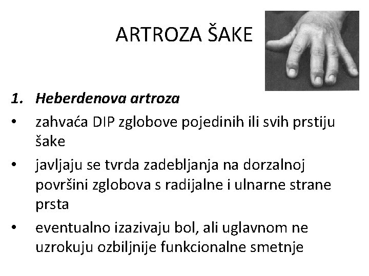 ARTROZA ŠAKE 1. Heberdenova artroza • zahvaća DIP zglobove pojedinih ili svih prstiju šake
