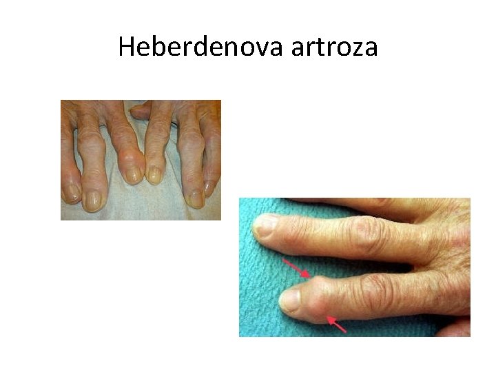Heberdenova artroza 