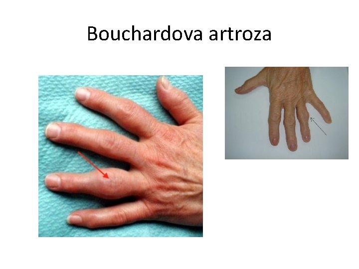 Bouchardova artroza 