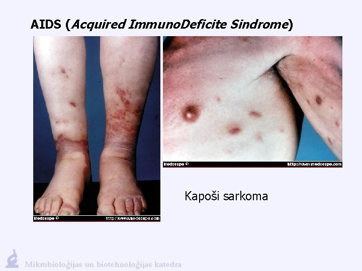 AIDS (Acquired Immuno. Deficite Sindrome) Kapoši sarkoma 