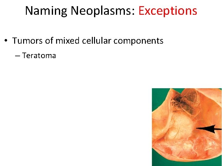 Naming Neoplasms: Exceptions • Tumors of mixed cellular components – Teratoma 