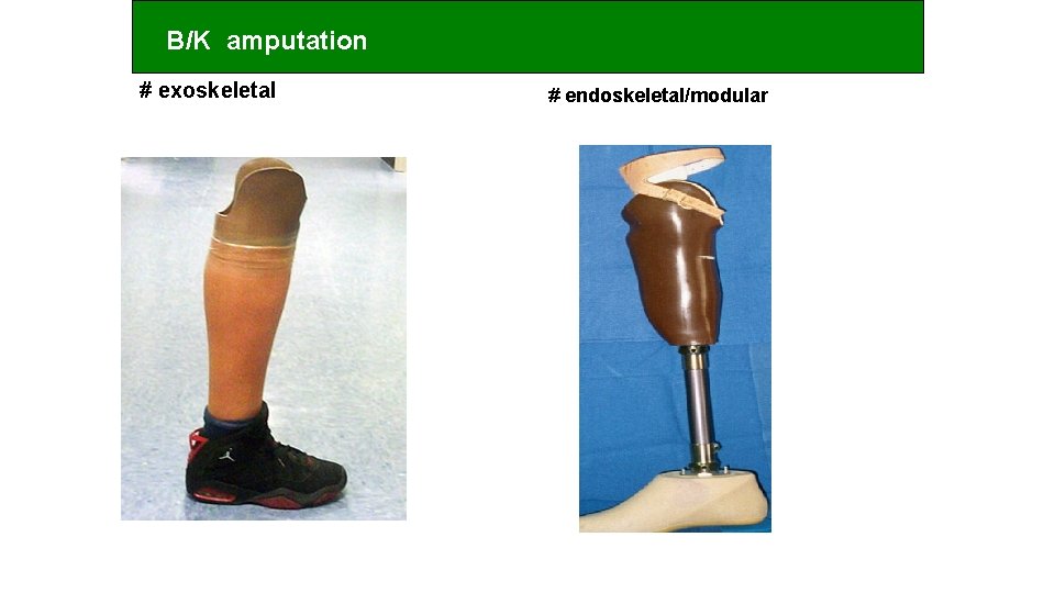 B/K amputation # exoskeletal # endoskeletal/modular 