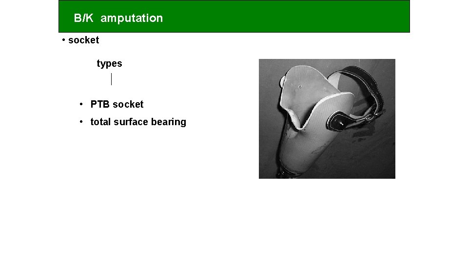 B/K amputation • socket types • PTB socket • total surface bearing 